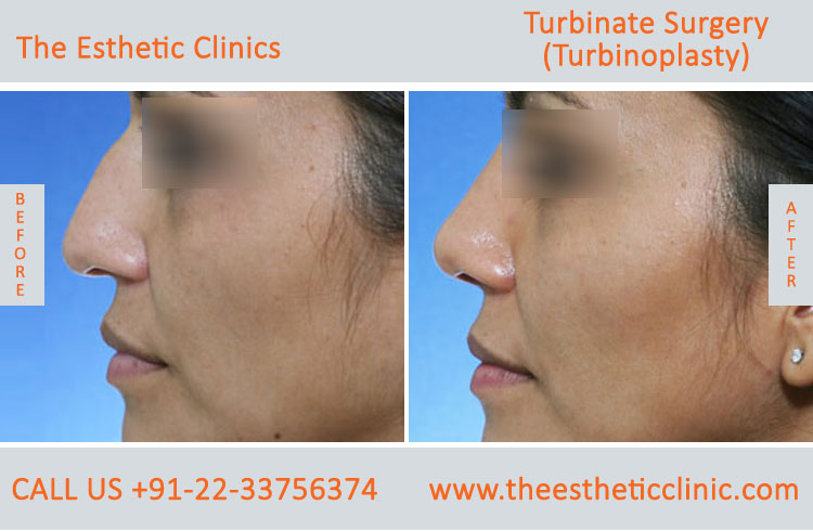 Turbinate Surgery, Turbinoplasty before after photos in mumbai india (6)